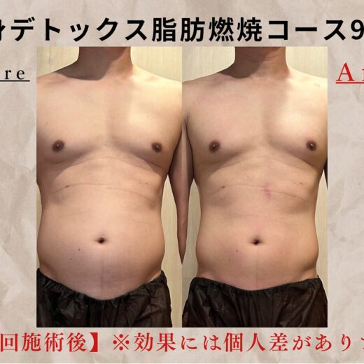 ぽっこりお腹撃退!
 <strong>全身デトックス脂肪燃焼撃退コース90分(3部位)</strong>

 最新複合マシン(シークレットメス)とEMS(パルストレーナー)を組み合わせた<strong>結果出しNo.1! 
リピート率No. 1最強メニュー!  </strong>
結果はもちろん、その後のリバウンドしづらい痩せやすいお身体造りまでサポート致します!